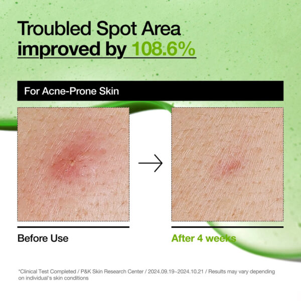 anua us ampoule serum azelaic acid 10 hyaluron redness soothing serum 1161173132